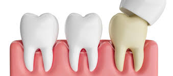 Dental Crown Costs and Insurance: Everything You Need to Know