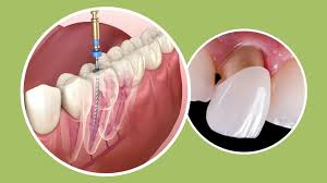 How Long Does it Take to Place a Dental Crown?