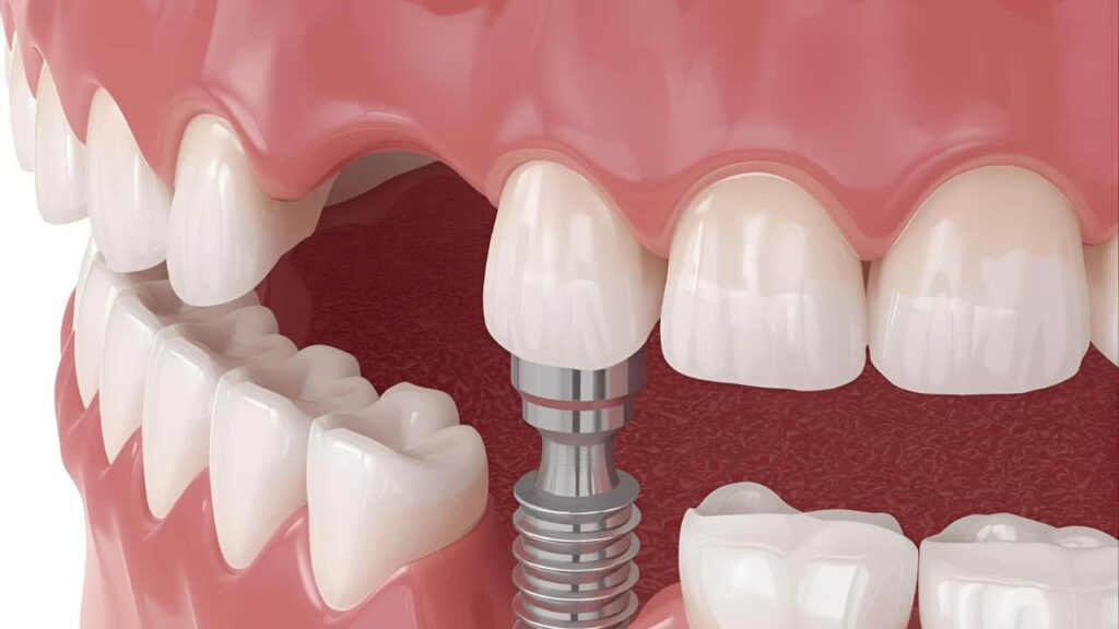 Fillings, Crowns, and Bridges in New Berlin | Restorative Dental Care