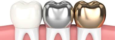 How Dental Crowns Are Made