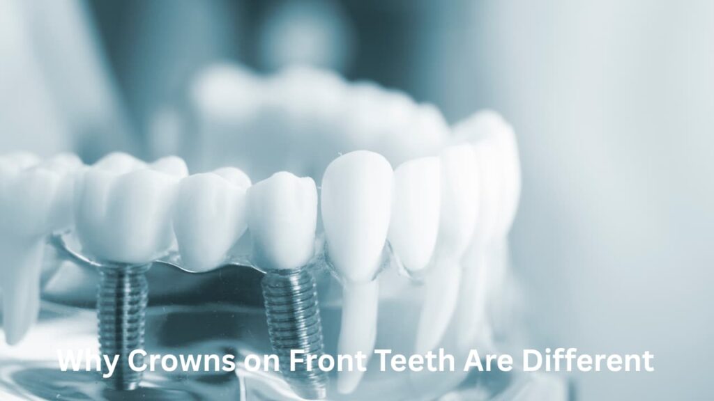Why Crowns on Front Teeth Are Different