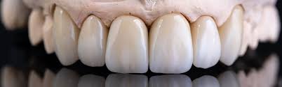 Zirconia Crowns: Your Complete Guide to Tooth Perfection