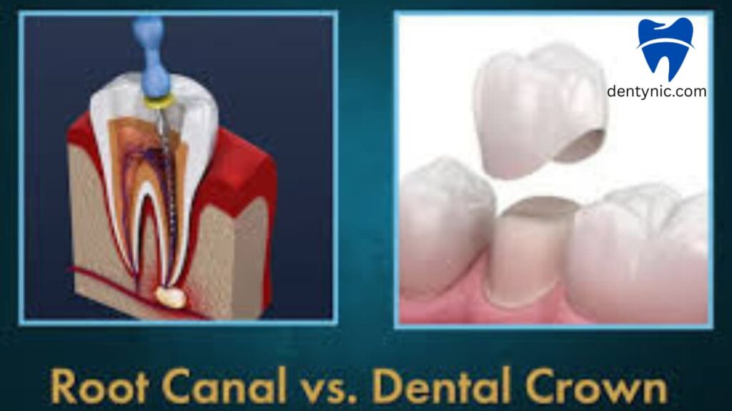 root-canal-vs-crown-how-are-they-different