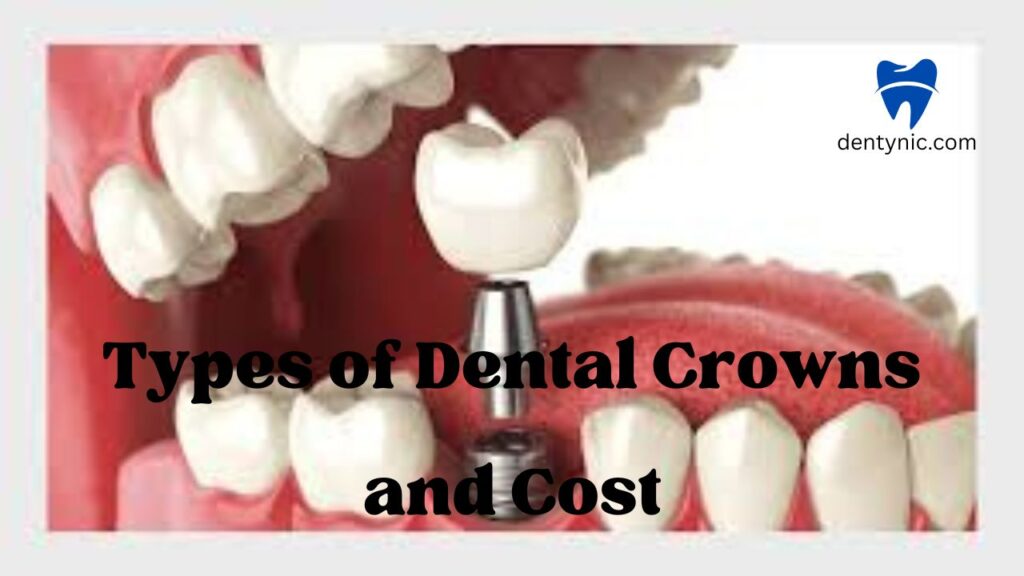 types-of-dental-crowns-and-cost-a-comprehensive-guide