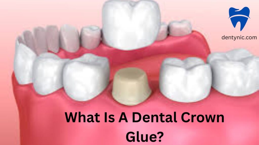 what-is-a-dental-crown-glue