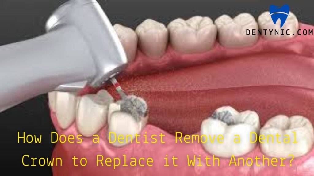 how-does-a-dentist-remove-a-dental-crown-to-replace-it-with-another