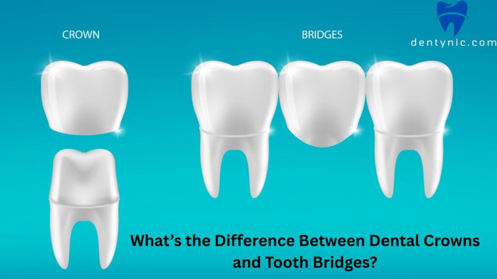 whats-the-difference-between-dental-crowns-and-tooth-bridges